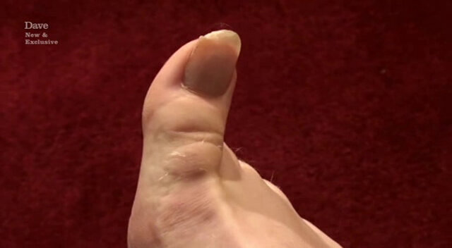 Image of Josh Widdicombe’s elongated big toenail.